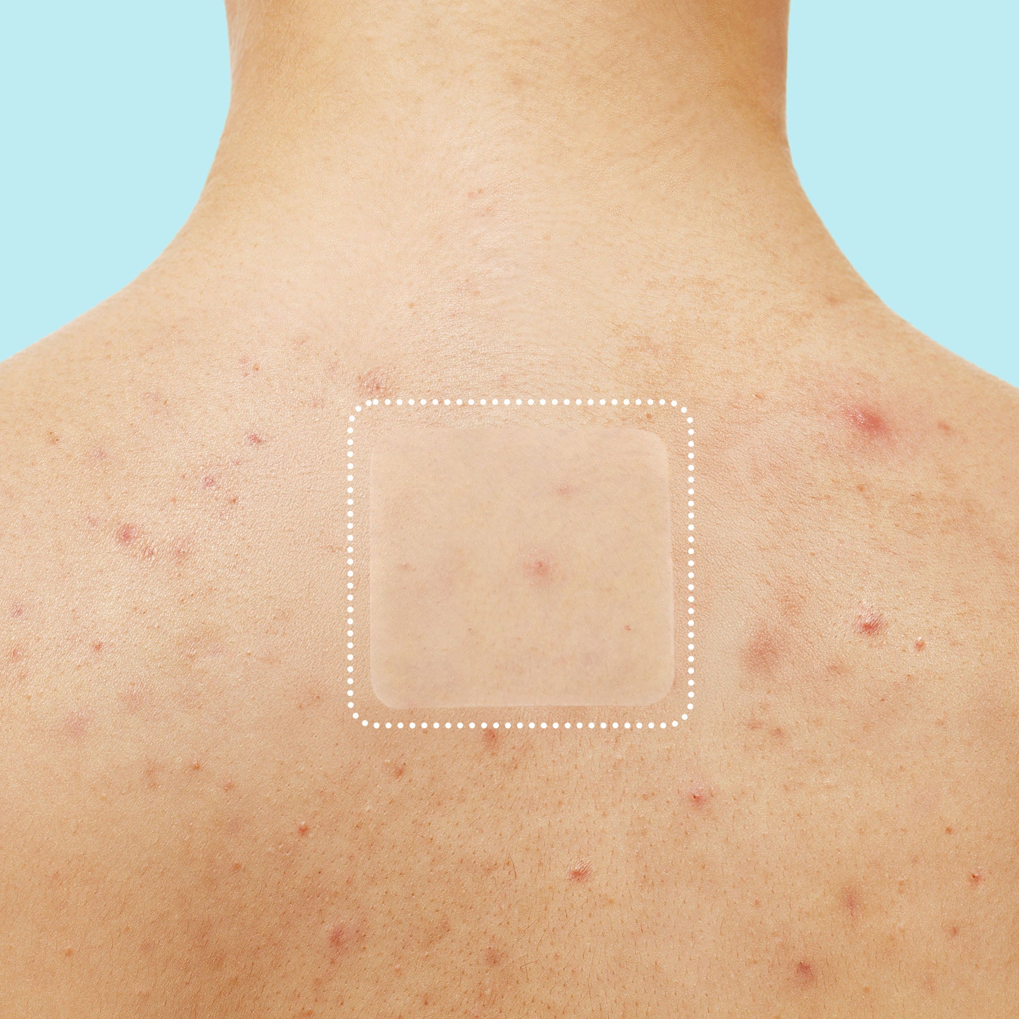 Miracle Patch XL Spot Control Cover - Original Collection dI